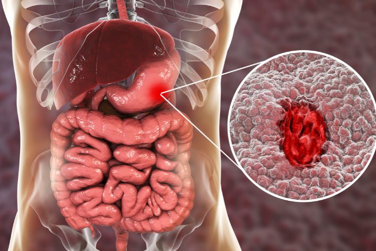 Treatment of Peptic Ulcers
